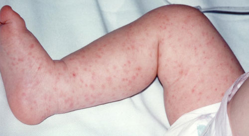 Hand, foot, and mouth disease in babies - BabyCenter Canada